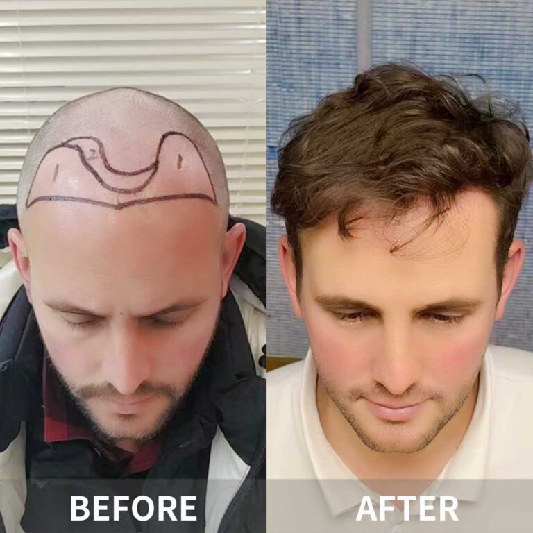 Shanghai Haircut and Hair Transplant: Hair Salon Challenges for Foreigners