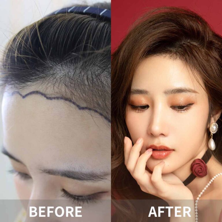 Hair Transplant in Hong Kong 2023 | Restore Your Confidence