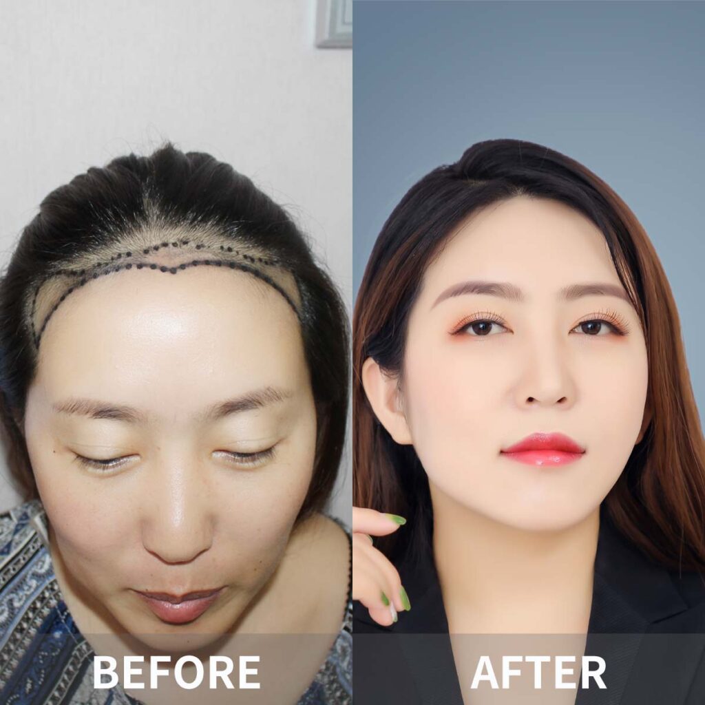 Best Hair Transplant in China