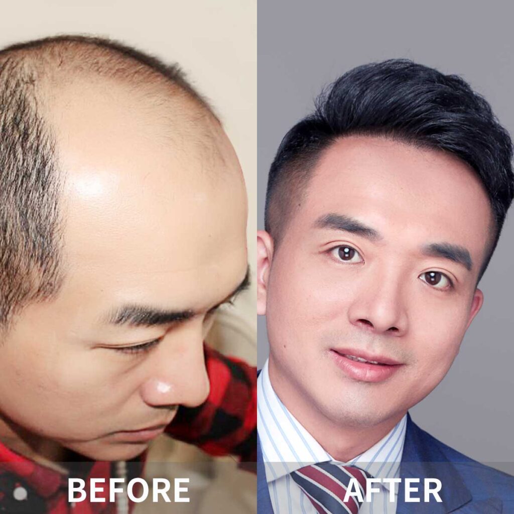 Hair Transplant cost in China