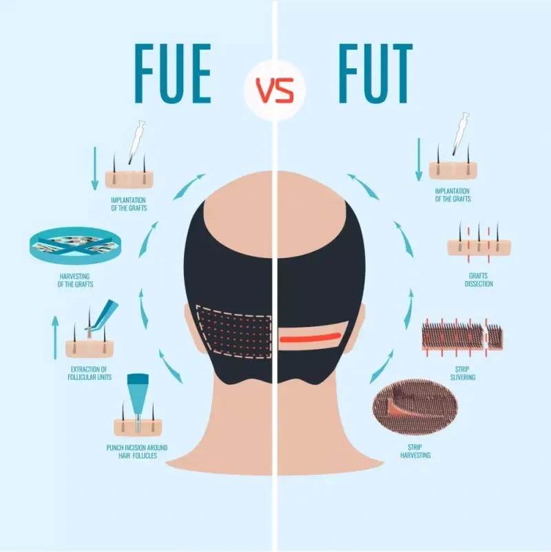 FUE Hair Transplant