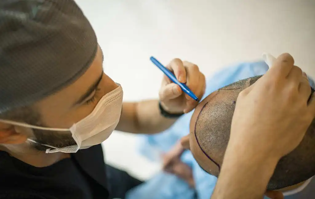 FUE Hair Transplant