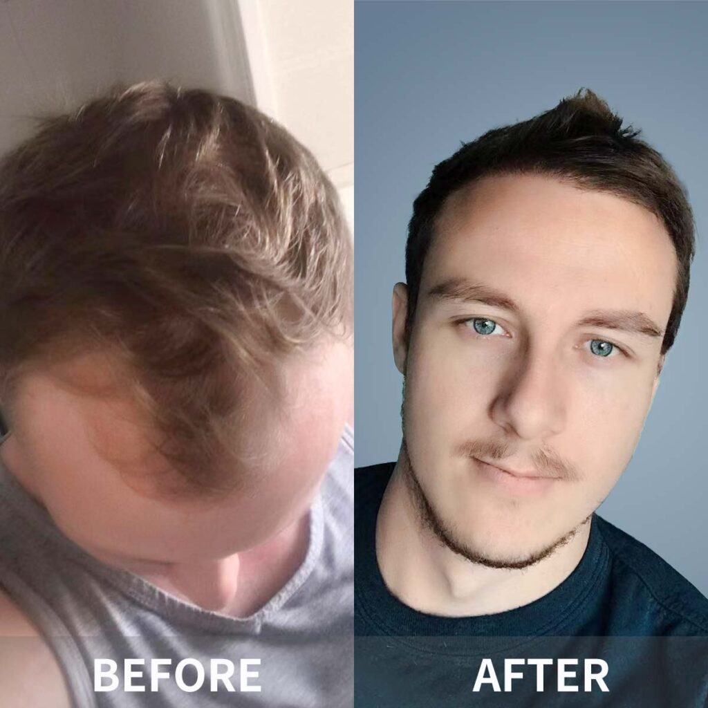 hair transplant painful